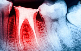 services-rootcanal