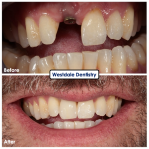 Westdale Dental | Dentist in Hamilton Dental Implants,dental implants near me,dental implants in hamilton